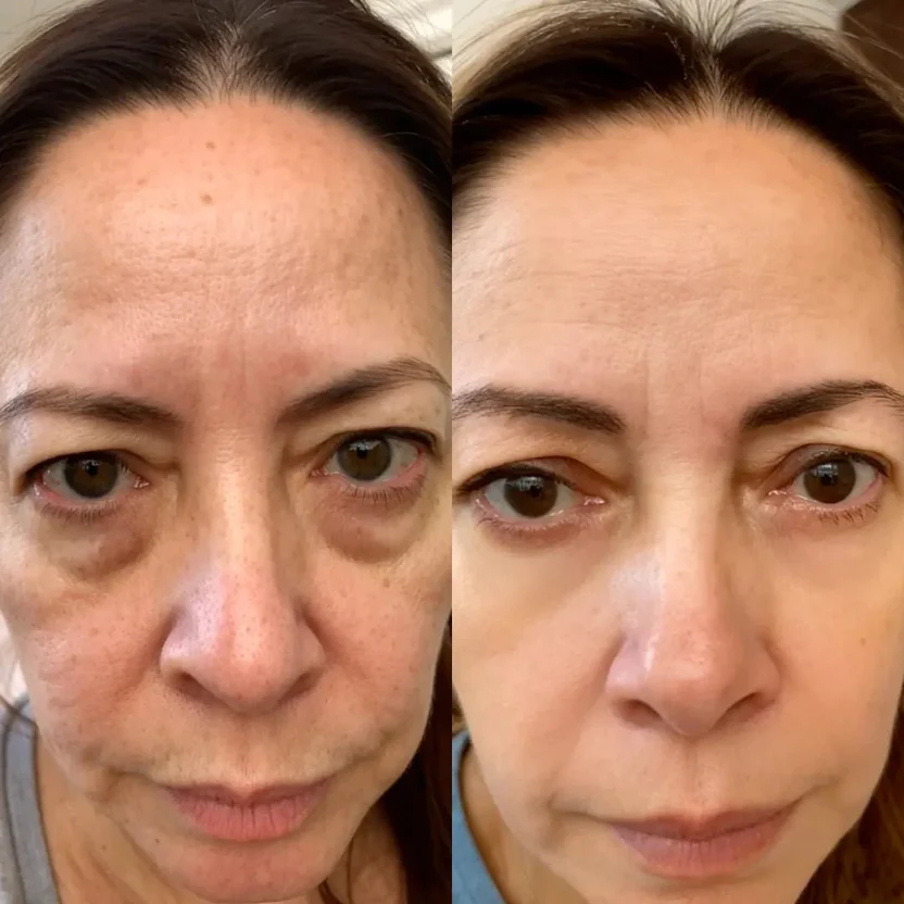 Regard Lift™ Before & After 2