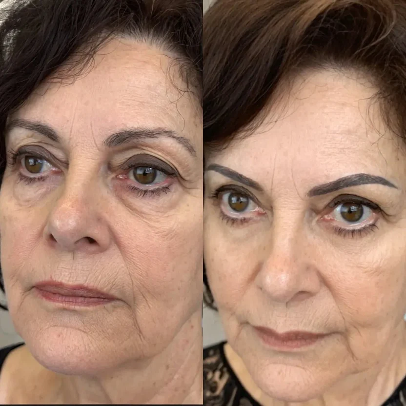 Regard Lift™ Before & After 3