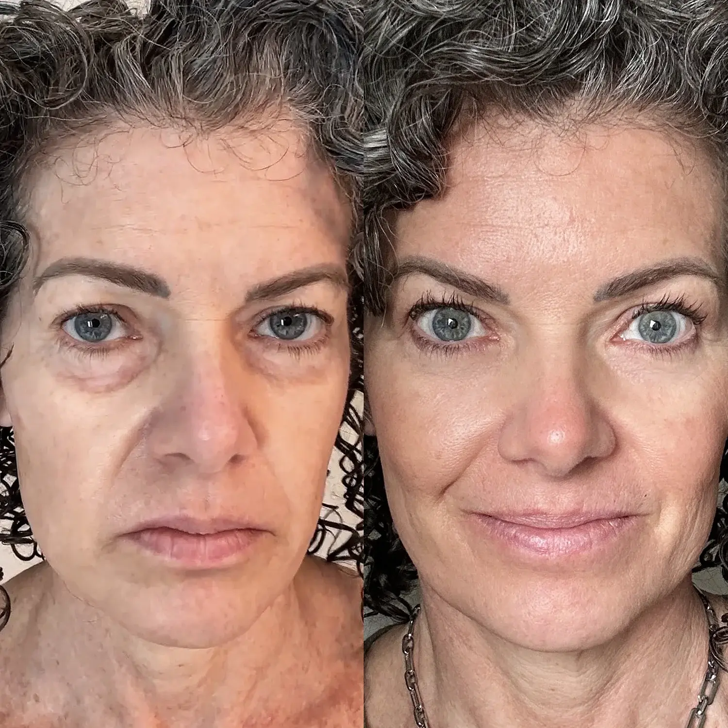 Avant et après de Gabrielle P. utilisant Regard Lift™