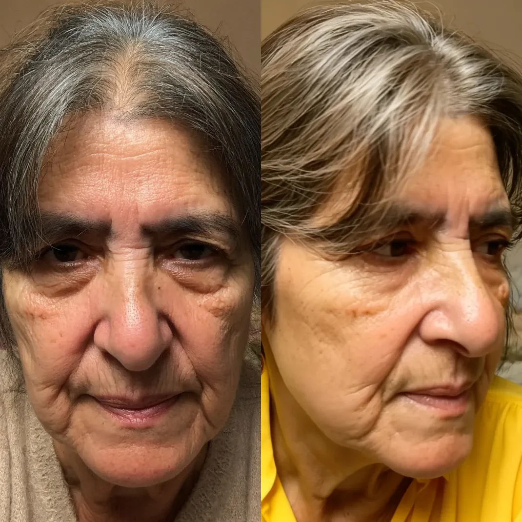 Avant et après de Arlene W. utilisant Regard Lift™