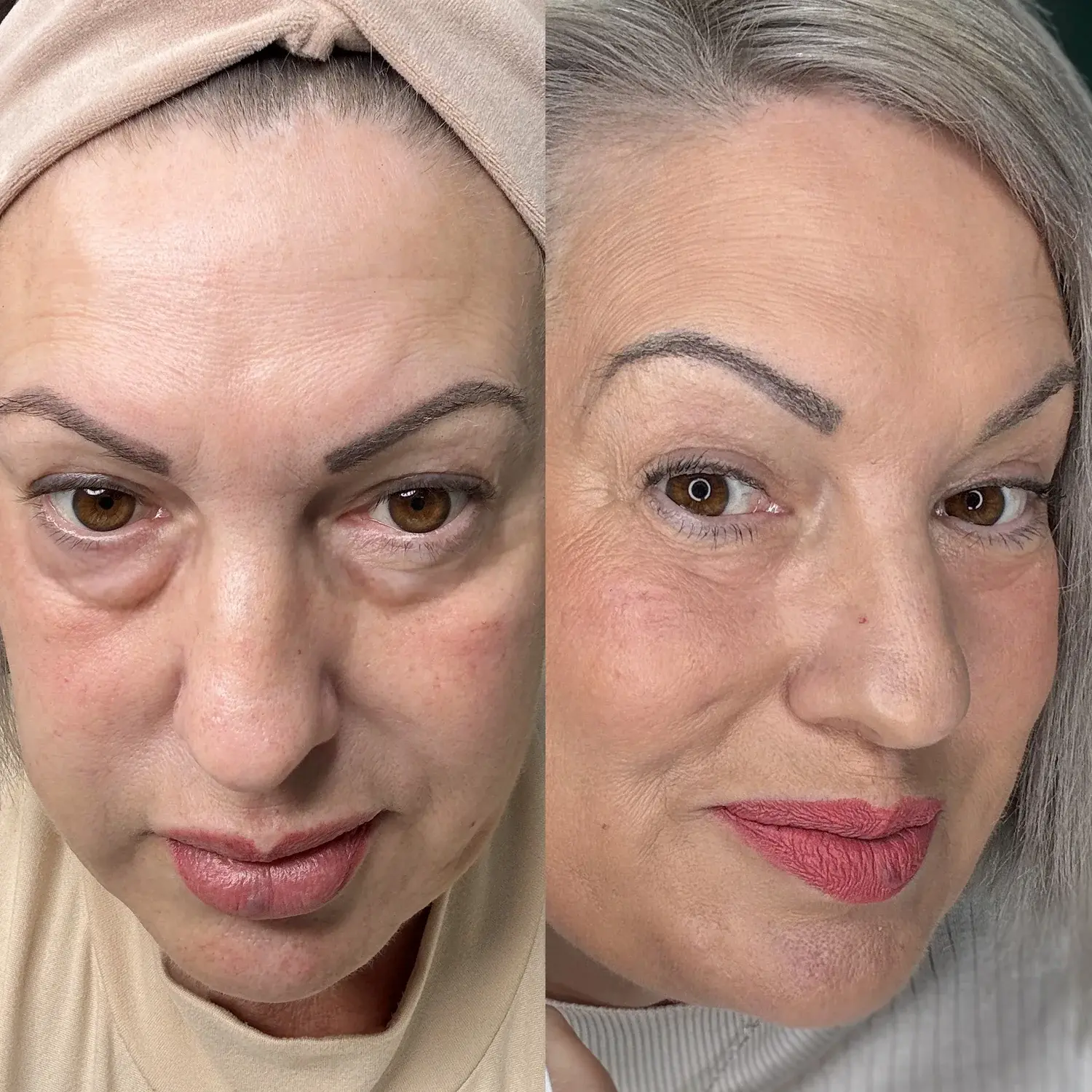 Avant et après de Mildred R. utilisant Regard Lift™