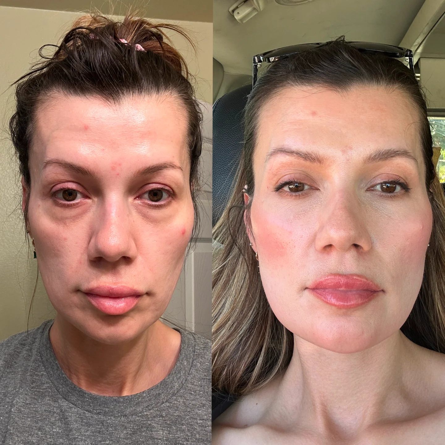 Regard Lift™ Before & After 1